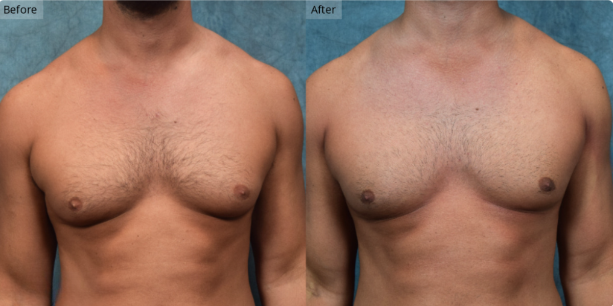 Patient #1-01 Stage 1 Gynecomastia Front