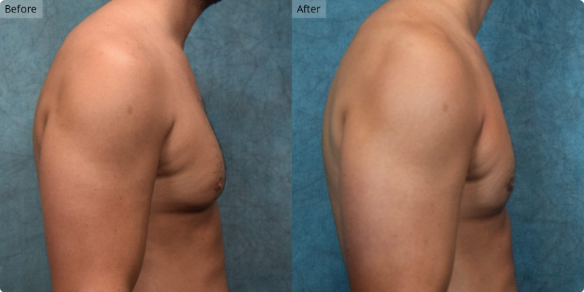 Patient #1-01 Stage 1 Gynecomastia Side