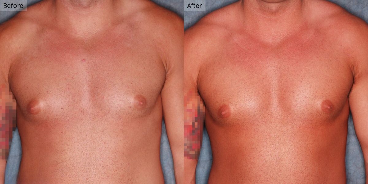 Patient #1-02 Stage 1 Gynecomastia Front