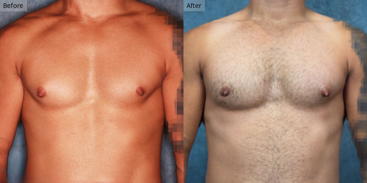 Patient #1-03 Stage 1 Gynecomastia Front