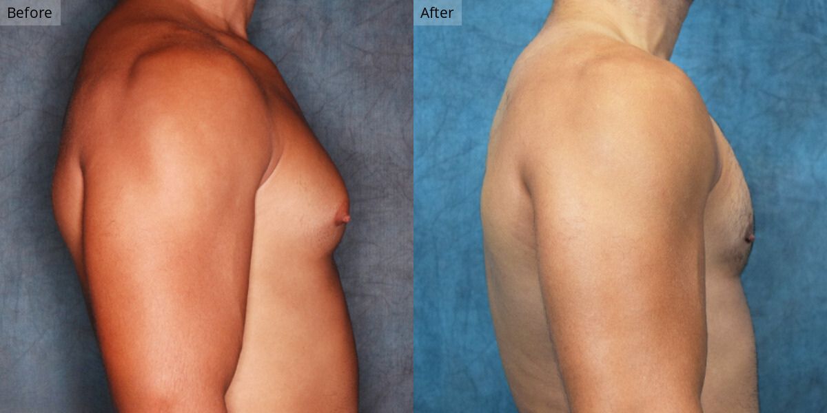 Patient #1-03 Stage 1 Gynecomastia Front