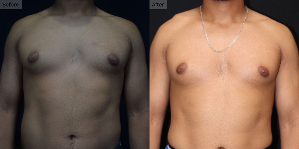 Patient #1-04 Stage 1 Gynecomastia Front