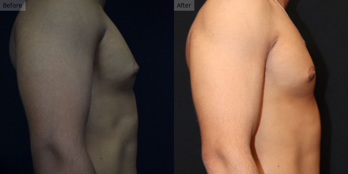 Patient #1-04 Stage 1 Gynecomastia Side