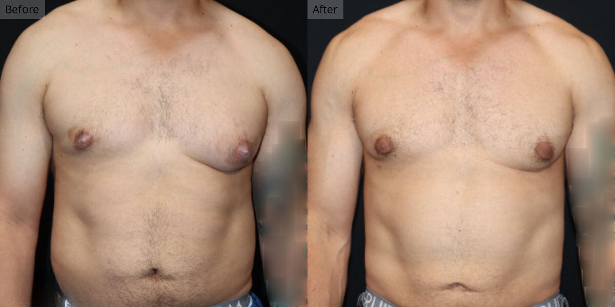 Patient #1-05 Stage 1 Gynecomastia Front