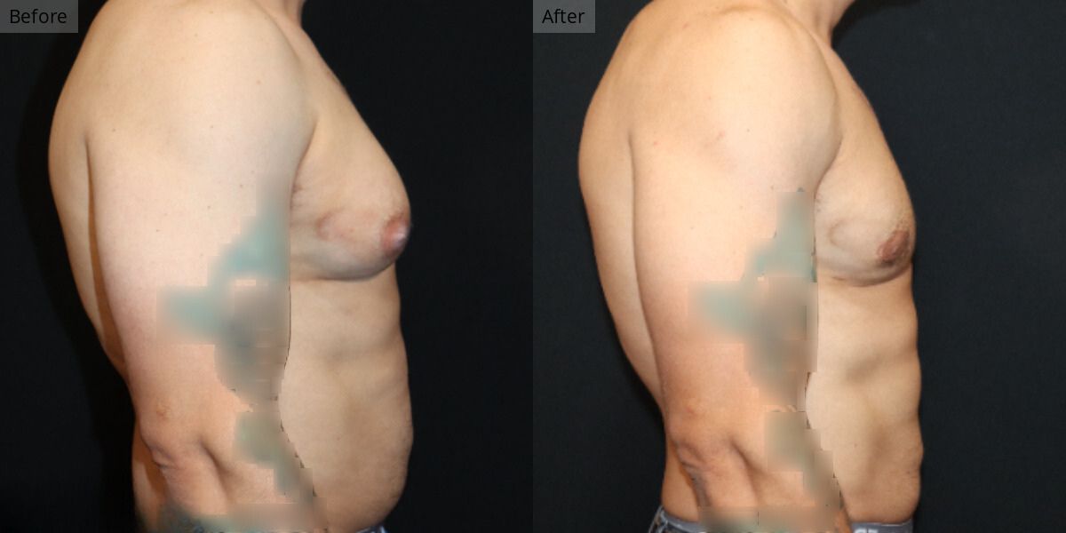 Patient #1-05 Stage 1 Gynecomastia Side