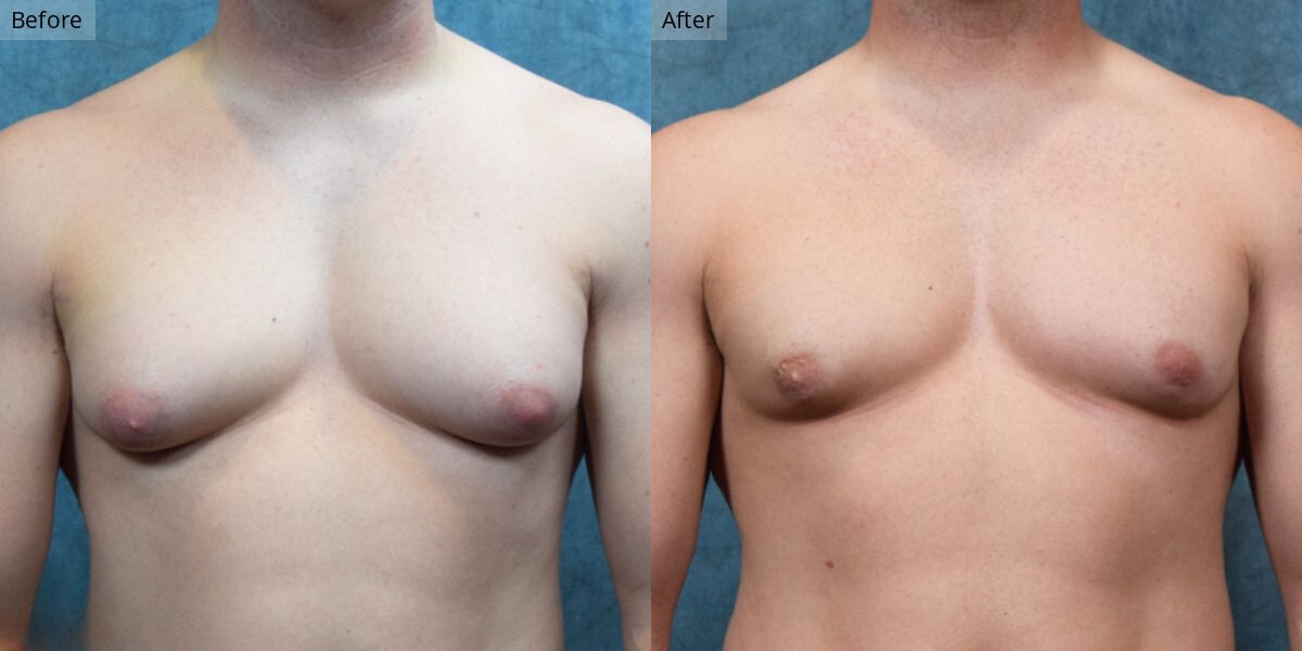 Patient #2-01 Stage 2 Gynecomastia Front