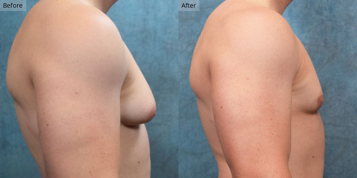 Patient #2-01 Stage 2 Gynecomastia Side