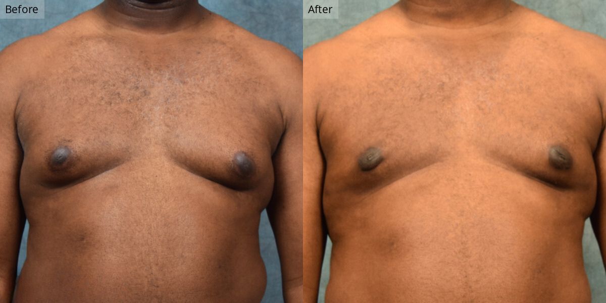 Patient #2-02 Stage 2 Gynecomastia Front