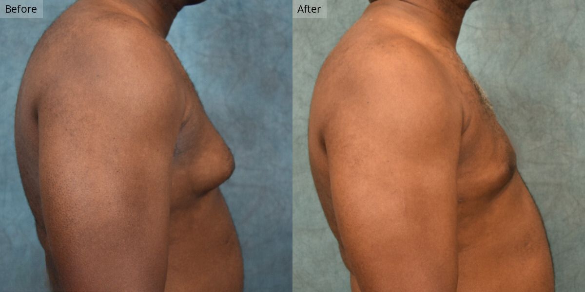 Patient #2-02 Stage 2 Gynecomastia Side