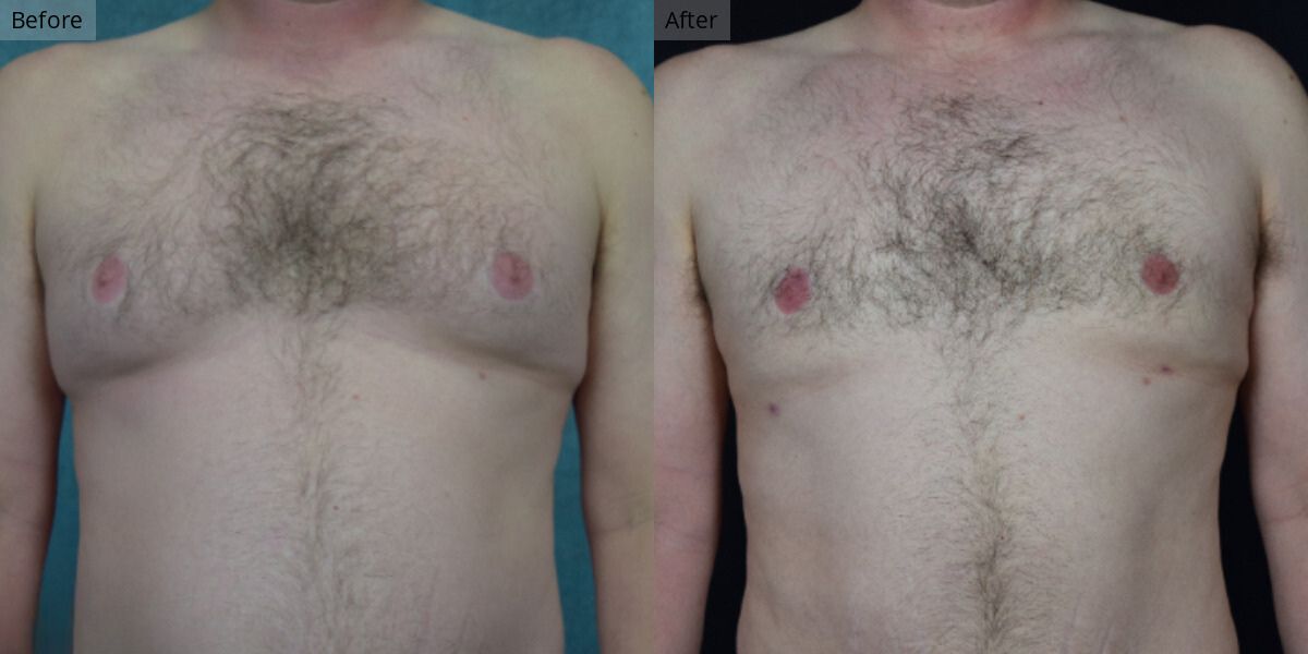 Patient #2-03 Stage 2 Gynecomastia Front