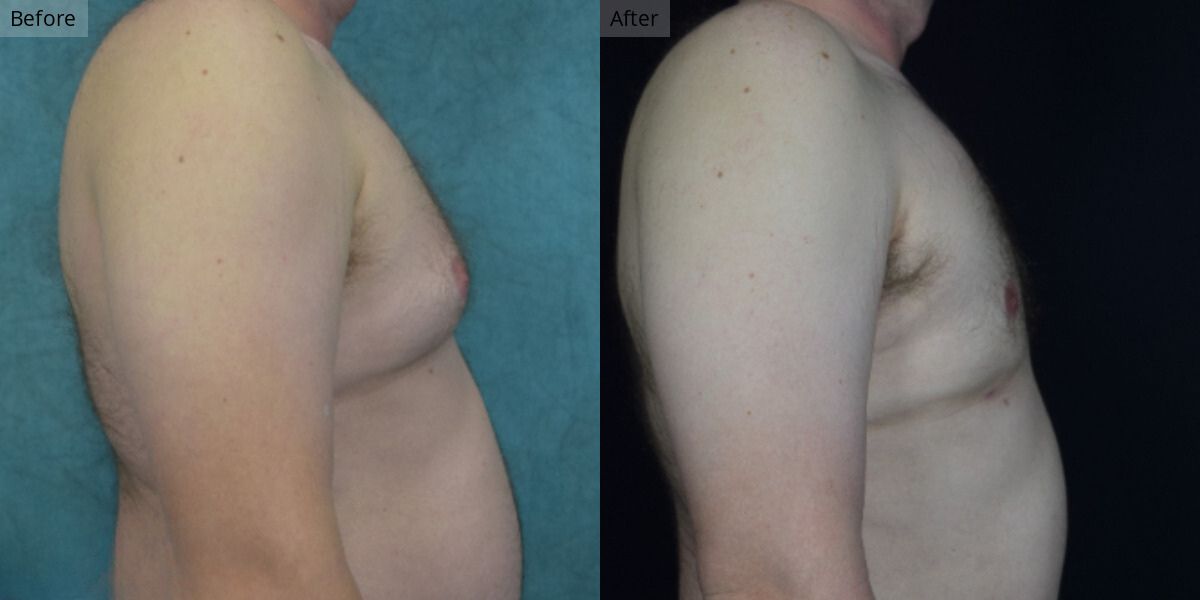 Patient #2-03 Stage 2 Gynecomastia Side