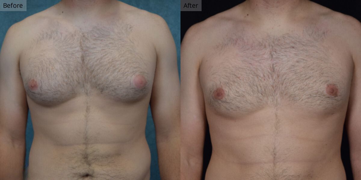 Patient #2-04 Stage 2 Gynecomastia Front