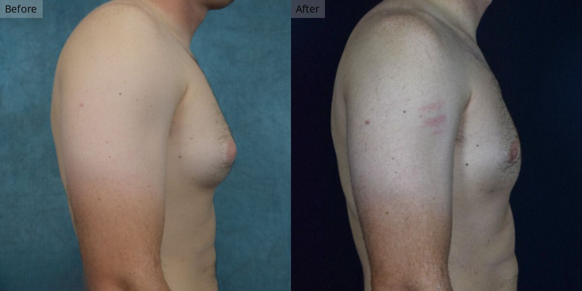 Patient Patient #2-04 Stage 2 Gynecomastia Side#2-04 Stage 2 Gynecomastia Side