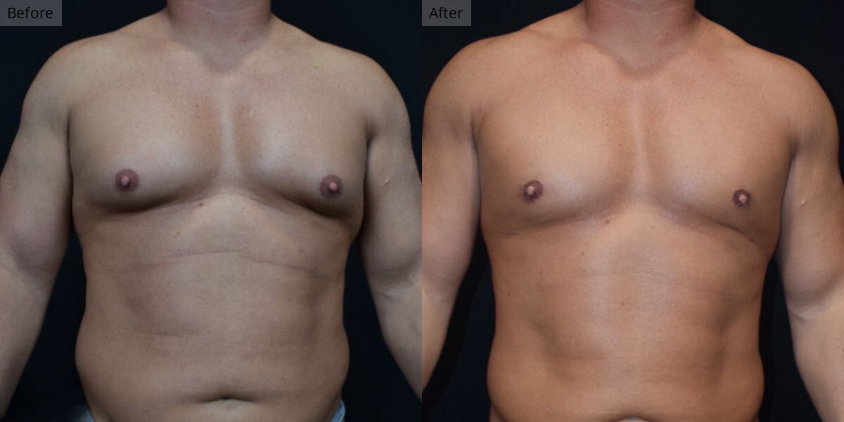 Patient #2-05 Stage 2 Gynecomastia Front