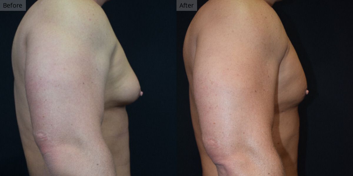 Patient #2-05 Stage 2 Gynecomastia Side