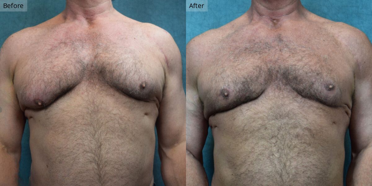 Patient #3-01 Stage 3 Gynecomastia Front