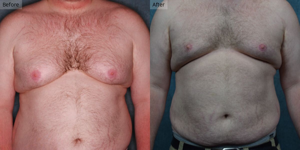 Patient #3-03 Stage 3 Gynecomastia Front