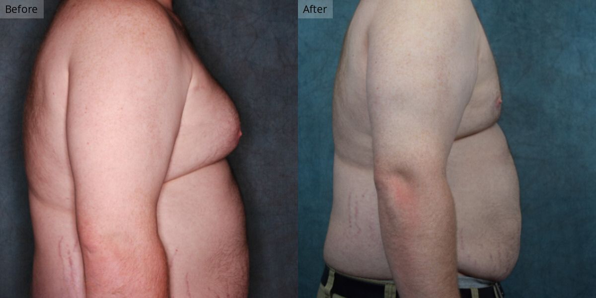 Patient #3-03 Stage 3 Gynecomastia Side