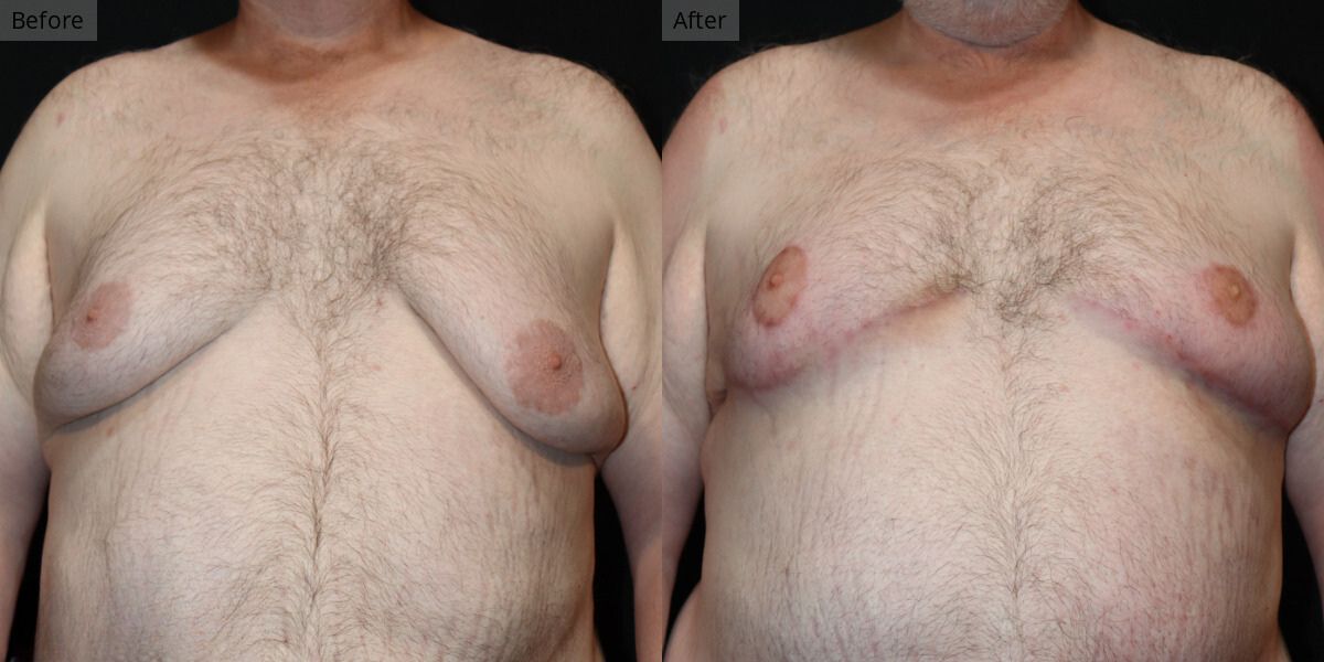 Patient #4-01 Stage 4 Gynecomastia Front