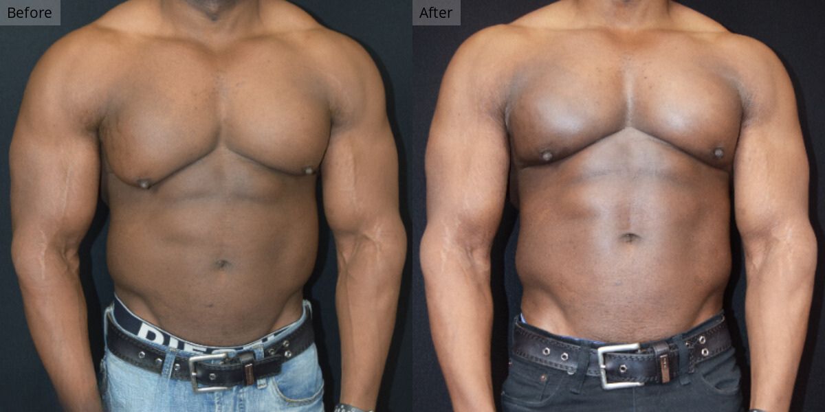 Patient #5-01 Bodybuilder Gynecomastia Front