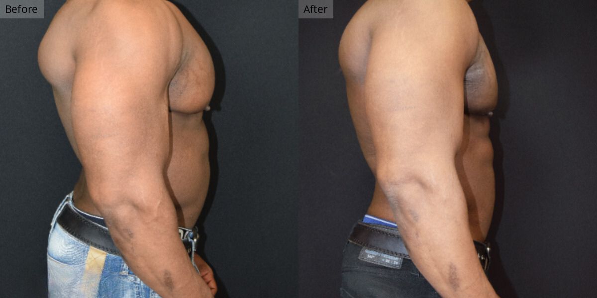 Patient #5-01 Bodybuilder Gynecomastia Side