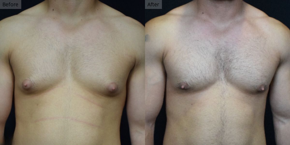 Patient #5-03 Bodybuilder Gynecomastia Front