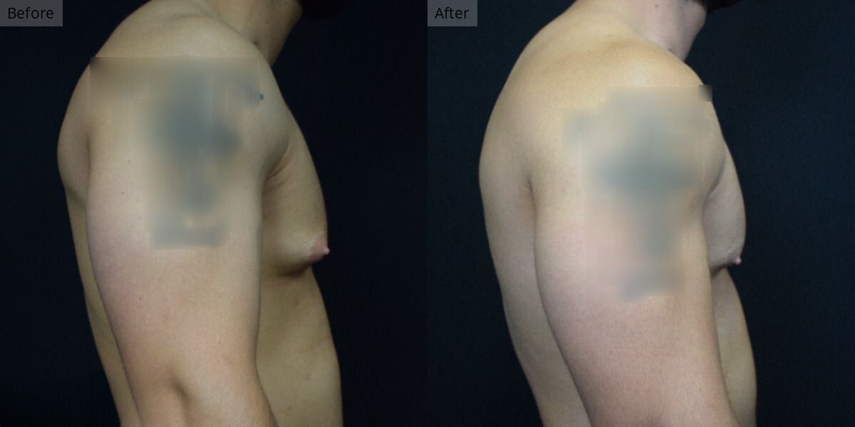 Patient #5-03 Bodybuilder Gynecomastia Side