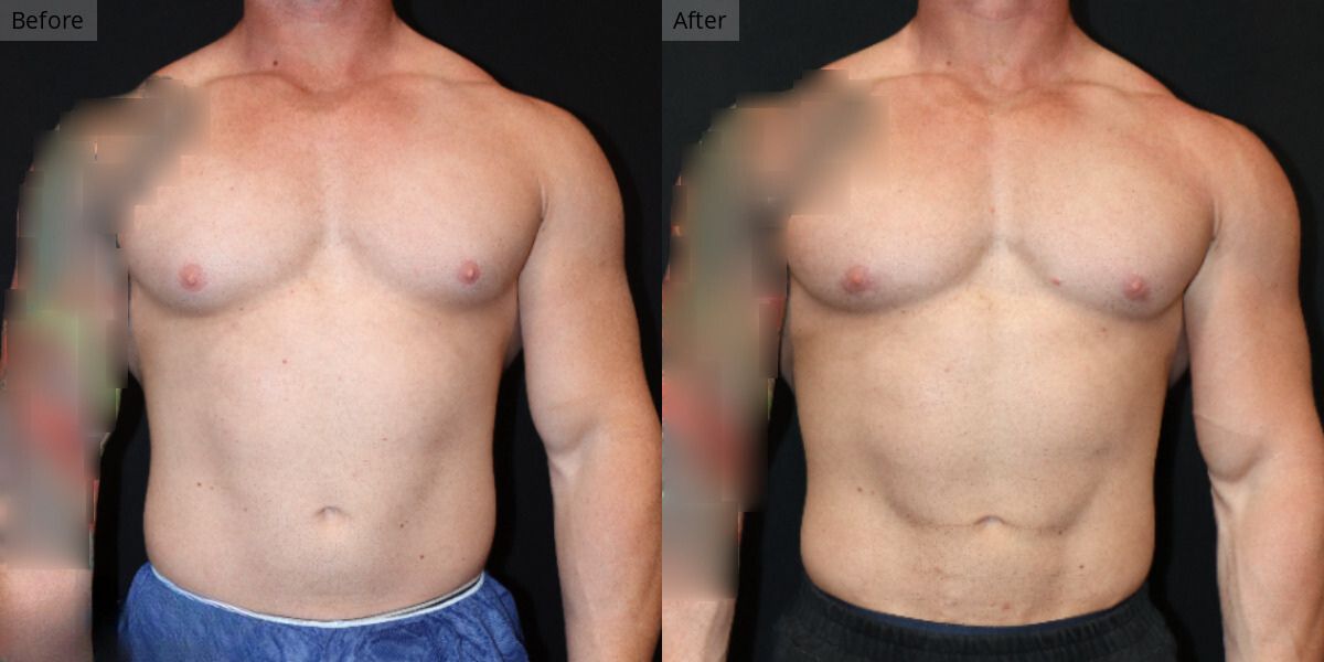 Patient #5-04 Bodybuilder Gynecomastia Front