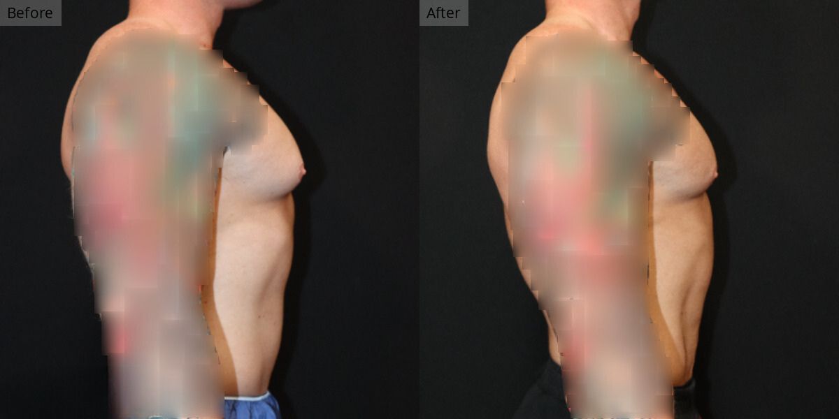 Patient #5-04 Bodybuilder Gynecomastia Side